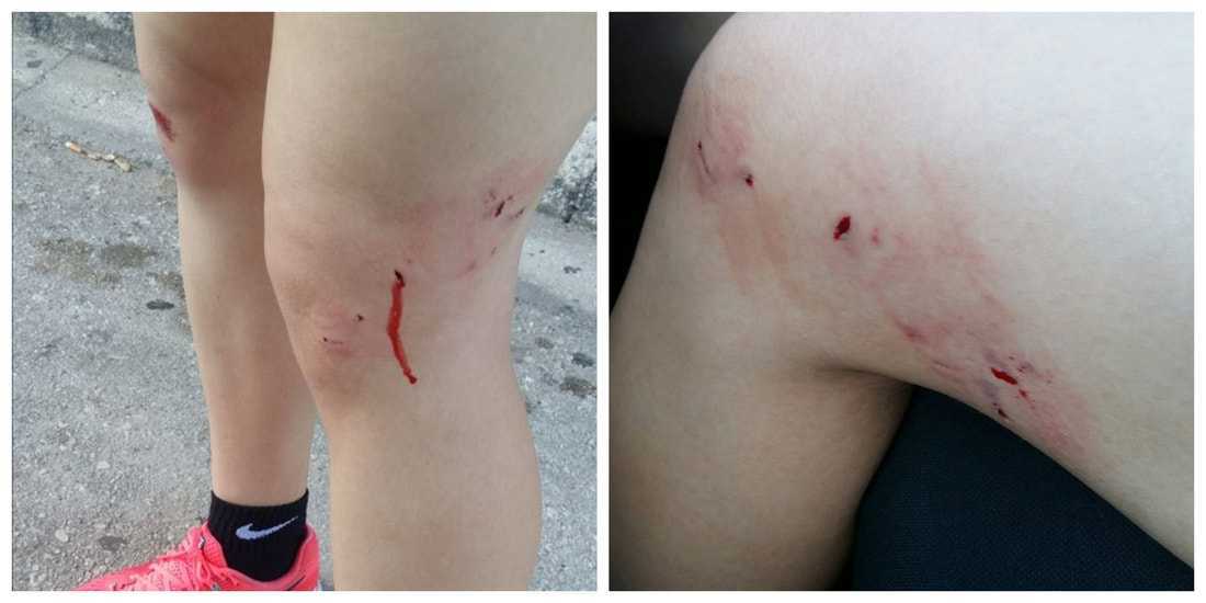 Εικόνες ΣΟΚ στην Άρτα: Αθλήτρια δέχθηκε επίθεση από αδέσποτο σκύλο στον δρόμο από Άρτα για Κεραμάτες!!