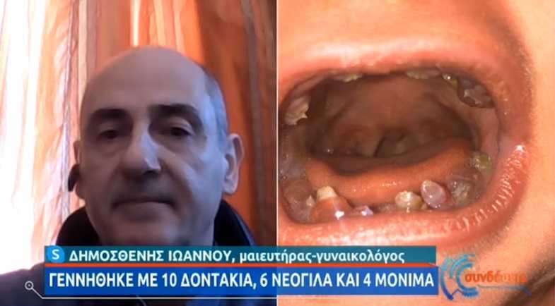 Μωράκι γεννήθηκε με 12 δόντια αφήνοντας άφωνους τους γιατρούς (Βίντεο)