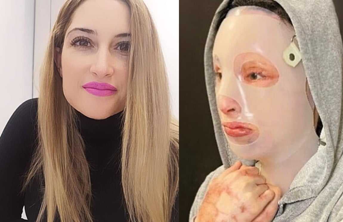 Φωτογραφία σοκ: Η Ιωάννα μας δείχνει τα εγκαύματά της μέσα από το νοσοκομείο, μετά το όγδοο χειρουργείο!