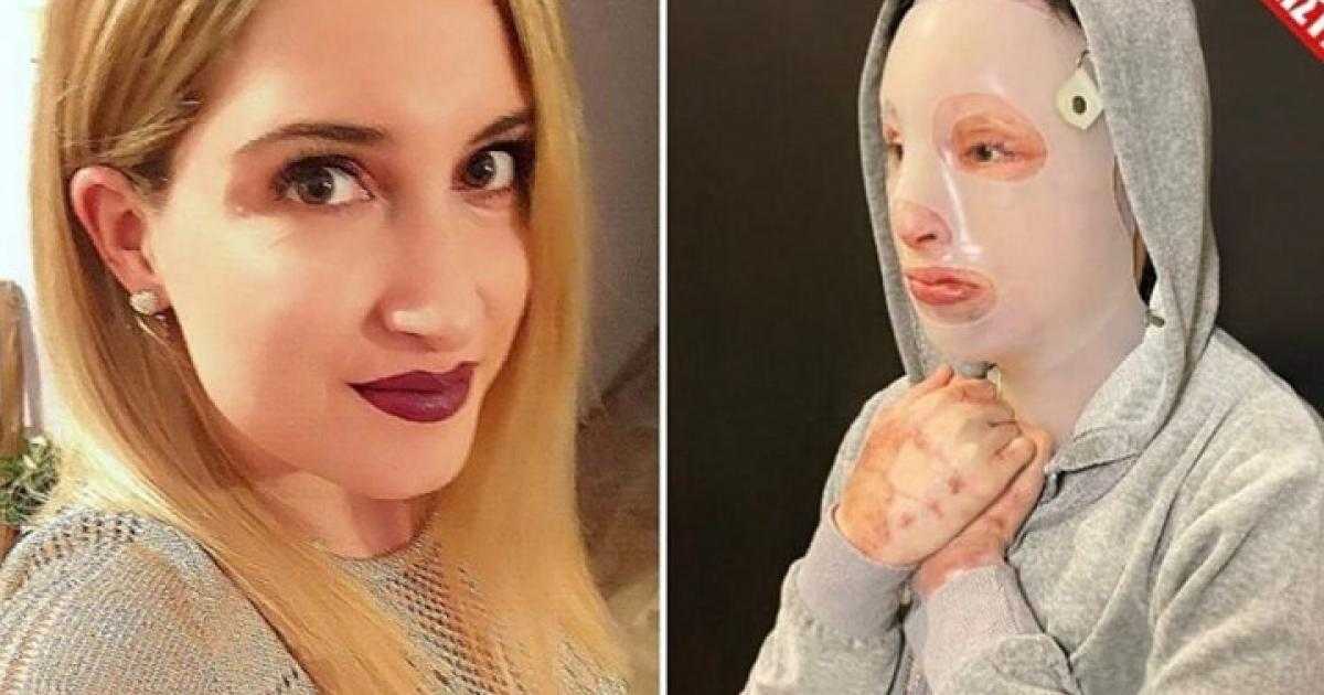 Επίθεση με βιτριόλι: Η φωτογραφία-σοκ που ανήρτησε η Ιωάννα Παλιοσπύρου (ΠΡΟΣΟΧΗ ΠΟΛΥ ΣΚΛΗΡΗ ΕΙΚΟΝΑ)