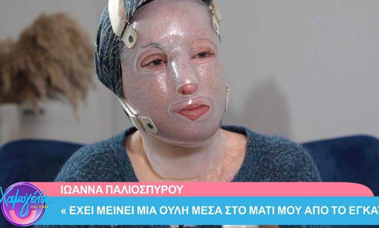 Η Ιωάννα Παλιοσπύρου έδειξε για πρώτη φορά τα εγκαύματά της και τα ρούχα που φόραγε την ημέρα της επίθεσης