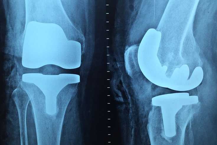 Όλα όσα θέλετε να γνωρίζετε για την αρθροπλαστική γόνατος