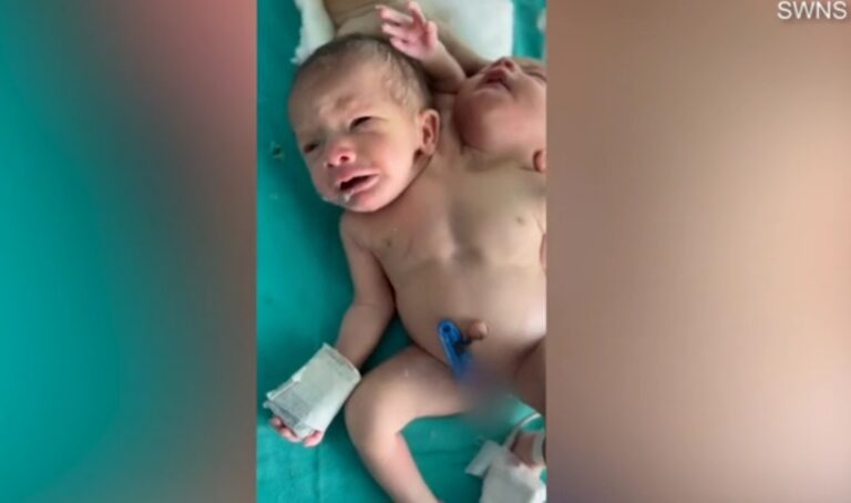 Γεννήθηκε μωρό με δύο κεφάλια και τρία χέρια: Έκπληκτοι οι γιατροί! (βίντεο)