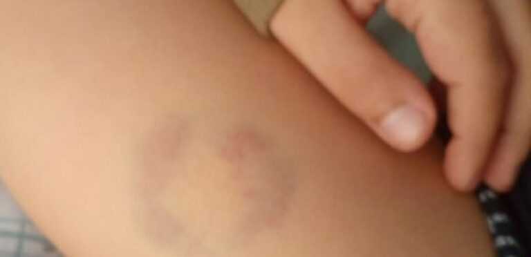 Άρτα: Στο Πειθαρχικό η διευθύντρια του ειδικού σχολείου που δάγκωσε 11χρονο μαθητή με αυτισμό