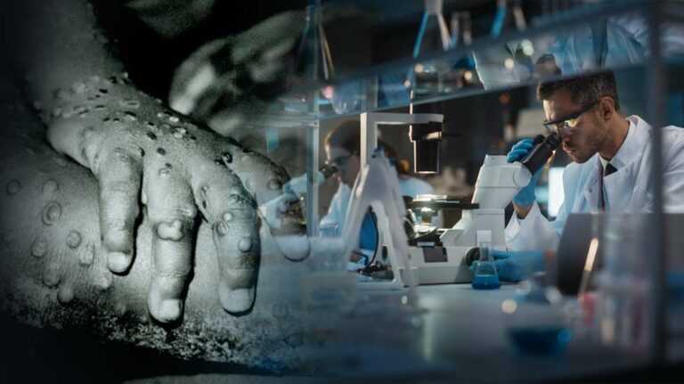 Λινού: «Με ανησυχεί η εξάπλωση της ευλογιάς των πιθήκων» -Φόβος για μεγάλη εξάπλωση το καλοκαίρι