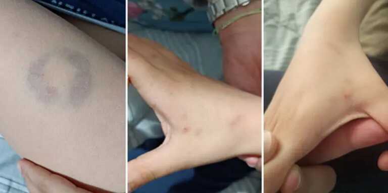 Σάλος στην Άρτα: Διευθύντρια σχολείου δάγκωσε 11χρονο μαθητή