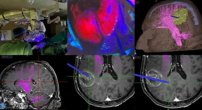 Πρωτοποριακή επέμβαση αφαίρεση κακοήθους όγκου εγκεφάλου στο Πανεπιστημιακό Γενικό Νοσοκομείο Ιωαννίνων
