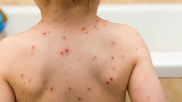 Χαμηλή η θετικότητα ιλαράς στην Ήπειρο