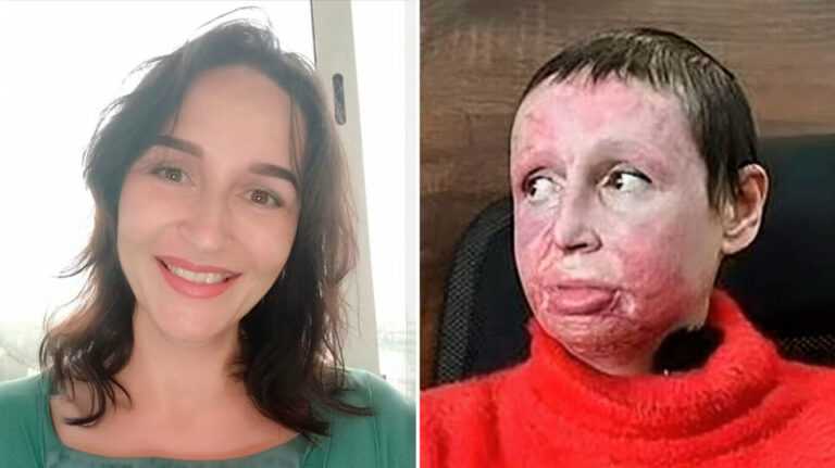 Ρωσία: Φρικιαστικό έγκλημα – 33χρονος βασάνισε και έβαλε φωτιά σε 40χρονη μετά τον χωρισμό τους